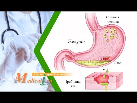 Видео: Прободная язва. Каковы причины? Какие симптомы? Как лечить?