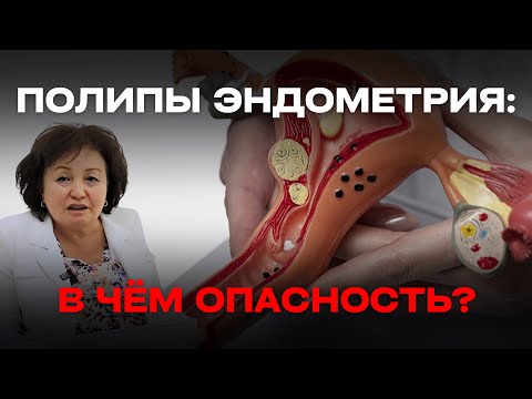 Видео: ПОЛИПЫ ЭНДОМЕТРИЯ: В ЧЁМ ОПАСНОСТЬ?