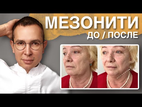 Видео: МЕЗОНИТИ ДО и ПОСЛЕ/ лечение возрастных изменений