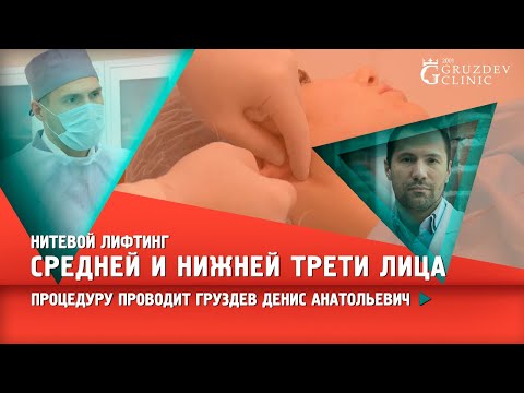 Видео: Нитевой лифтинг средней и нижней трети лица