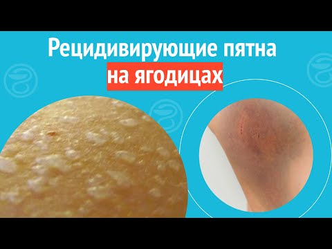 Видео: 🦵🦵 Рецидивирующие пятна на ягодицах. Клинический случай №1143