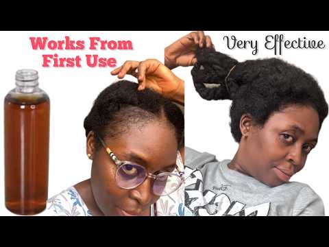 Видео: Сверхмощный тоник для роста волос при алопеции, содержащий 3 мощных ингредиента для восстановлени...