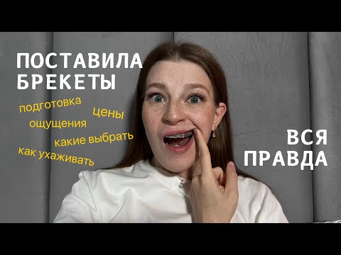 Видео: Брекеты установка дешево | моя история | влог | цена | что есть |гигиена | посмотри, перед лечением