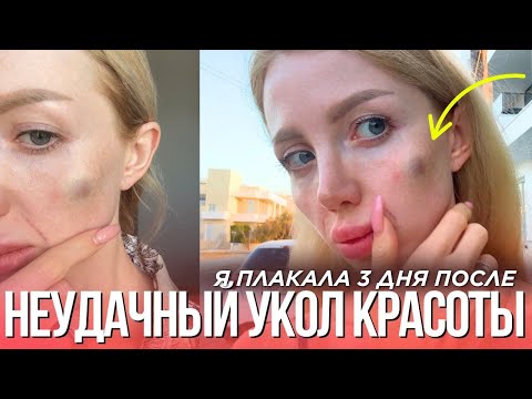 Видео: МОЙ ПОХОД К КОСМЕТОЛОГУ ОБЕРНУЛСЯ ДРАМОЙ. НОСОГУБКА, СКУЛЫ И РАДИЕСС. МОЙ ГОРЬКИЙ ОПЫТ