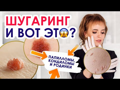 Видео: ШУГАРИНГ И ПАПИЛЛОМЫ |  Особенности кожи | Папилломы, кондиломы и родинки – противопоказания?
