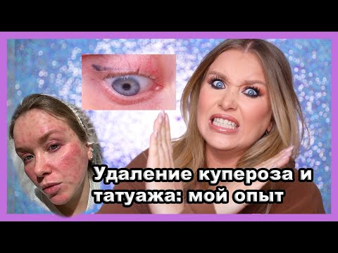 Видео: УДАЛИЛА ТАТУАЖ И КУПЕРОЗ I История длиной в год