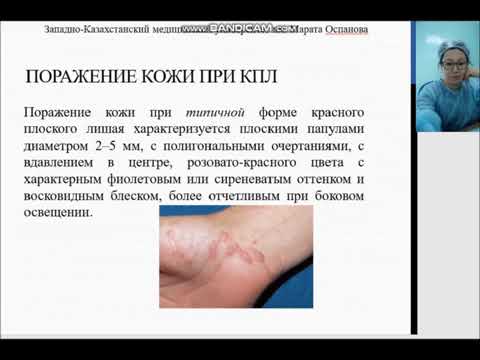 Видео: Красный  плоский лишай лекция к.м.н доцент Изтлеуова Гульмира Маратовна