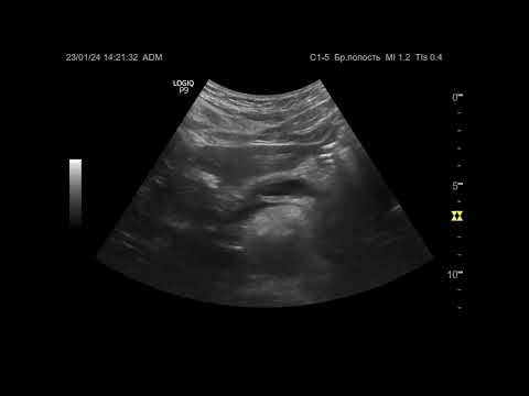 Видео: Ультразвуковая диагностика (УЗИ). Доктор Иогансен. Видеопримеры. Выпуск 58. Панкреатолитиаз.