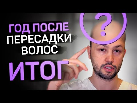 Видео: Пересадка волос. Год спустя. Полный итоговый отчет.