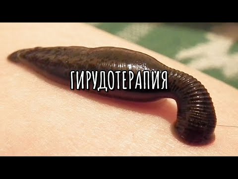 Видео: ГИРУДОТЕРАПИЯ