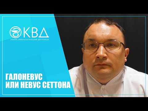 Видео: 1282  Галоневус или невус Сеттона