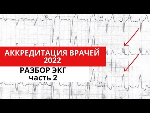 Видео: Разбор ЭКГ из АККРЕДИТАЦИИ 2022 года (для кардиологов, терапевтов, функциональных диагностов)Часть 2