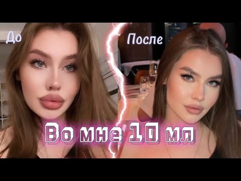 Видео: Увеличение губ. Sardenya, stylage M/L. Лонгидаза/липораза