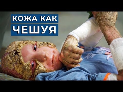 Видео: Мой сын словно ГНИЁТ ЗАЖИВО, "ЧЕШУЯ" вместо кожи / Синдром KID, Ихтиоз