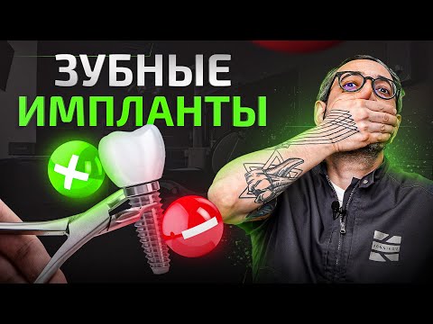 Видео: Имплантация зубов все ЗА и ПРОТИВ. Зубные импланты