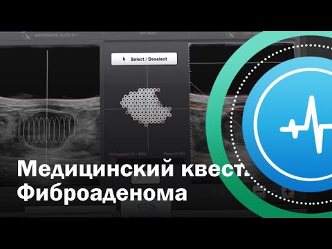 Видео: Медицинский квест. Фиброаденома