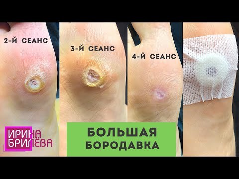 Видео: История удаления БОРОДАВКИ 🌸 Динамика за НЕСКОЛЬКО СЕАНСОВ 🌸 Препаратный педикюр 🌸 Ирина Брилёва