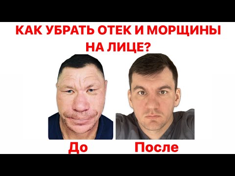 Видео: Навсегда убрал отек на лице и морщины и стал на столько красивым что женился на королеве Англии