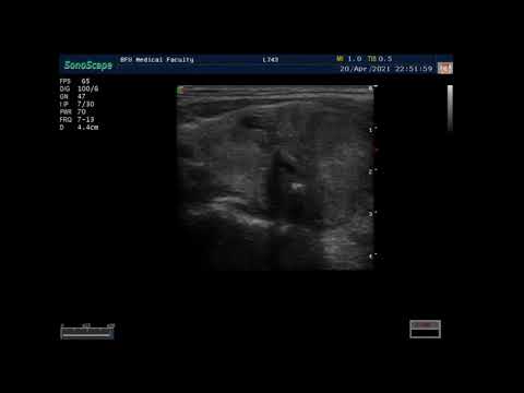 Видео: УЗИ щитовидной железы. Пациент 4