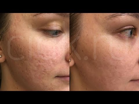 Видео: ДНЕВНИК ПОСТАКНЕ: ЛЕЧИМ РУБЦЫ (ШЛИФОВКА, КОЛЛОСТ, СКИНБУСТЕР)