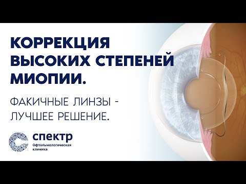 Видео: Коррекция зрения высоких степеней миопии - лучшее решение это факичные линзы.
