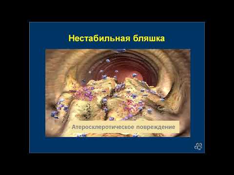 Видео: Школа врача-интерна. «Дифференциальная диагностика и лечение острых коронарных синдромов»