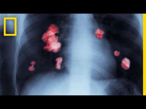 Видео: Рак 101 | National Geographic