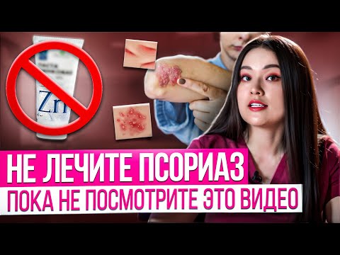 Видео: ПСОРИАЗ - причины, подробно о лечении, признаки и симптомы псориаза. Новые методы лечения псориаза.