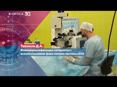 Видео: Факоэмульсификация катаракты с использованием фако-витрео системы EVA (Тихонов Д.А.)