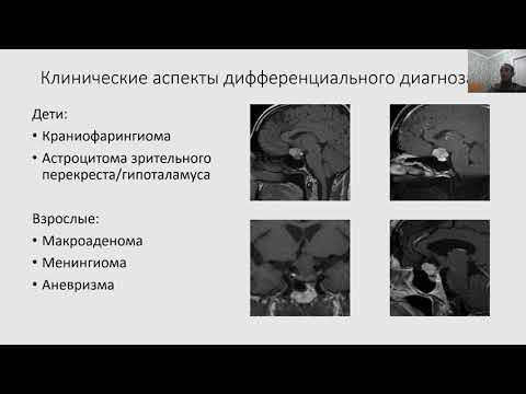 Видео: МРТ. Гипофиз, эпифиз, внемозговые опухоли. Лектор Е.Н. Суровцев