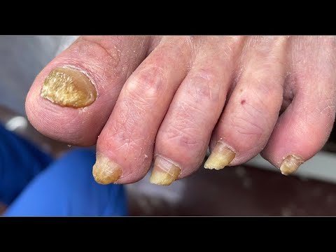 Видео: Онихогрифозные ногти!!! Частичный педикюр