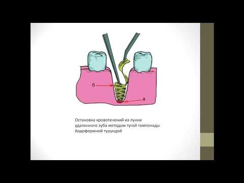 Видео: Основы хирургической стоматологии 1. Возможные осложнения после удаления зубов