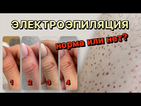 Видео: Реакция кожи после электроэпиляции - что норма, а что нет | ЭЛЕКТРОЭПИЛЯЦИЯ