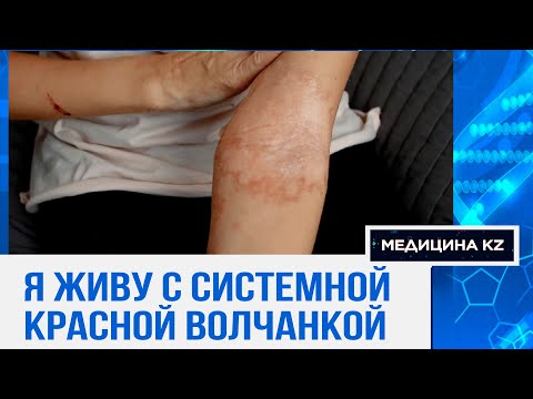 Видео: Болезнь Леди Гаги и Селены Гомес: что такое системная красная волчанка, и как живут с ней в РК