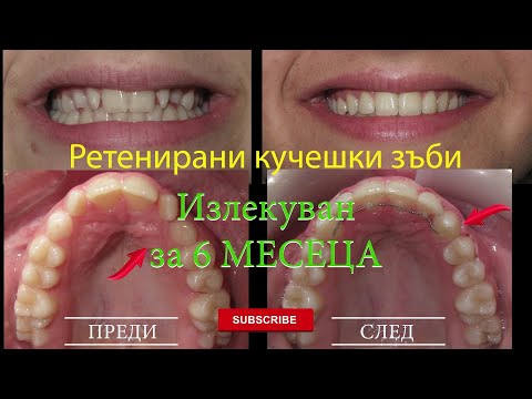 Видео: РЕТЕНИРАНИ КУЧЕШКИ ЗЪБИ, излекуван САМО за 6 месеца! #ортодонтия #ортодонт #брекети