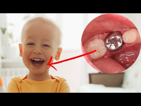 Видео: Металлические коронки на молочные зубы.