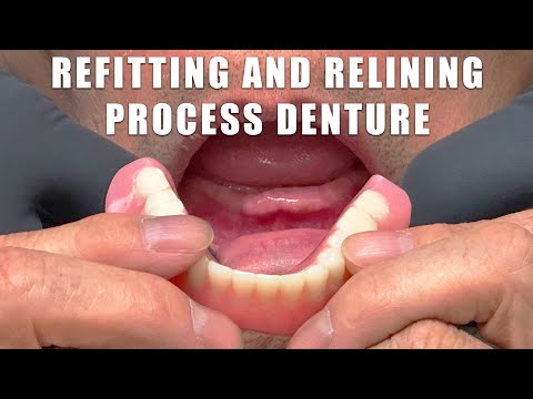 Видео: Переподгонка и перебазировка съемного протеза