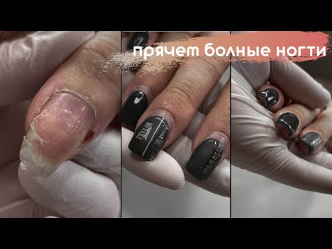 Видео: Онихолизис. ТАК ДЕЛАТЬ НЕЛЬЗЯ!!! Перекрываем больные ногти