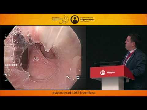 Видео: Эндоскопическое лечение дивертикула Ценкера. Что может быть нового?