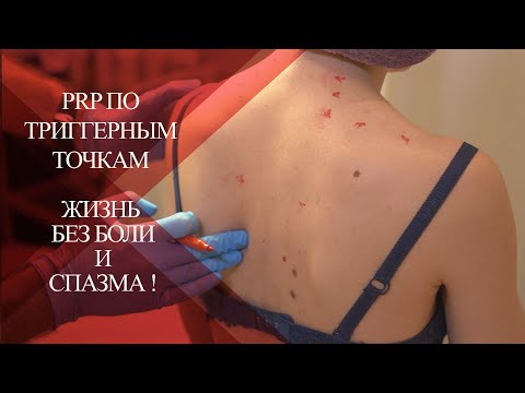Видео: 💉Как снять БОЛЬ в шее и спине PRP по триггерным точкам | 20 триггеров  на спине в одной процедуре!