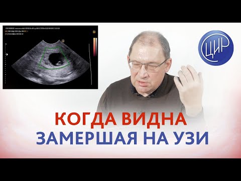 Видео: Замершая беременность: на каком сроке УЗИ точно покажет замершую беременность? Гузов И.И.