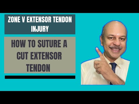 Видео: Травма разгибателя в зоне V: как восстановить разорванное сухожилие разгибателя и как проводить д...