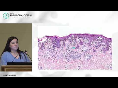 Видео: Как видит опухоль патоморфолог в микроскоп? (Чуглова Д.А.)