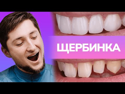 Видео: Малоинвазивное протезирование - Дентал Кейсы
