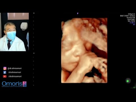 Видео: ВЕНТРИКУЛОМЕГАЛИЯ, что это такое? - 25 недель беременности