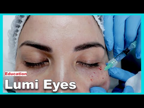 Видео: Точки инъекционной техники Lumi Eyes и фотографии до и после