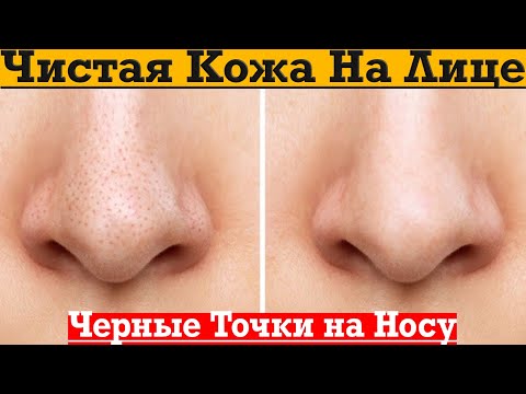 Видео: Чистые поры на носу, убираем комедоны и чёрные точки на коже!