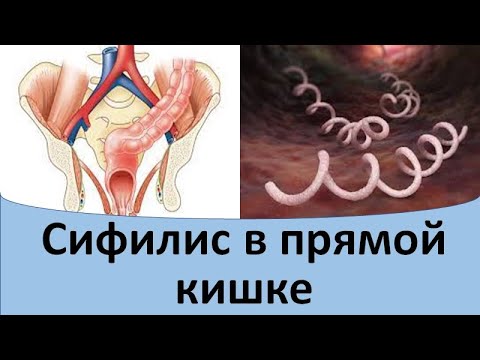 Видео: Сифилис в прямой кишке