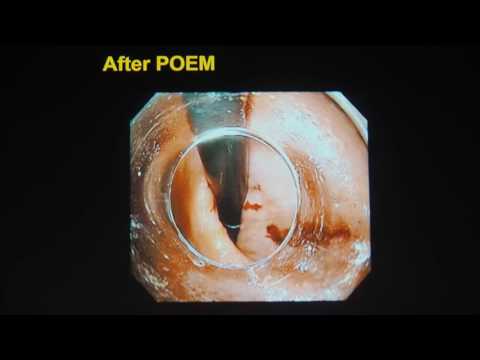 Видео: 01 Haruhiro Inoue   POEM при ахалазии пищевода