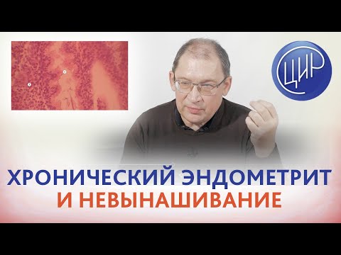 Видео: Обследование после неудачной беременности. Хронический эндометрит. Гузов И.И.